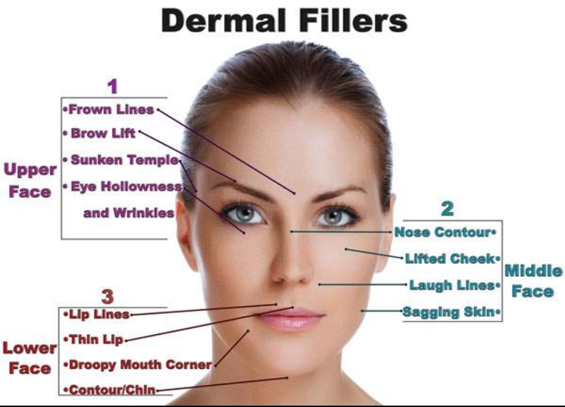 where dermal fillers can help with aging