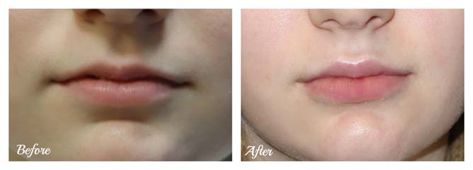 lips2
