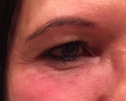 Redensity Eyes - After