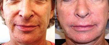 Before - After