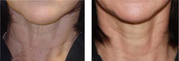 Before - After