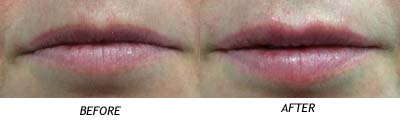 LIPS