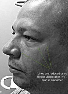 After RegenPlasma Treatment
