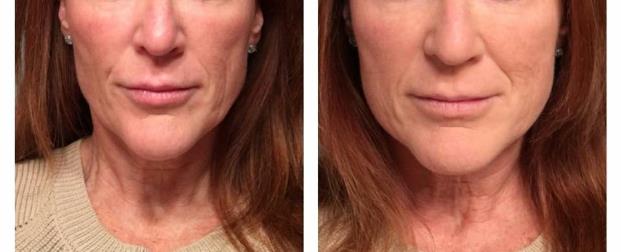 Filler - mid face. Before and after on day of treatment. Redensity has vitamins and anti-oxidants. The results will improve over 6 weeks.