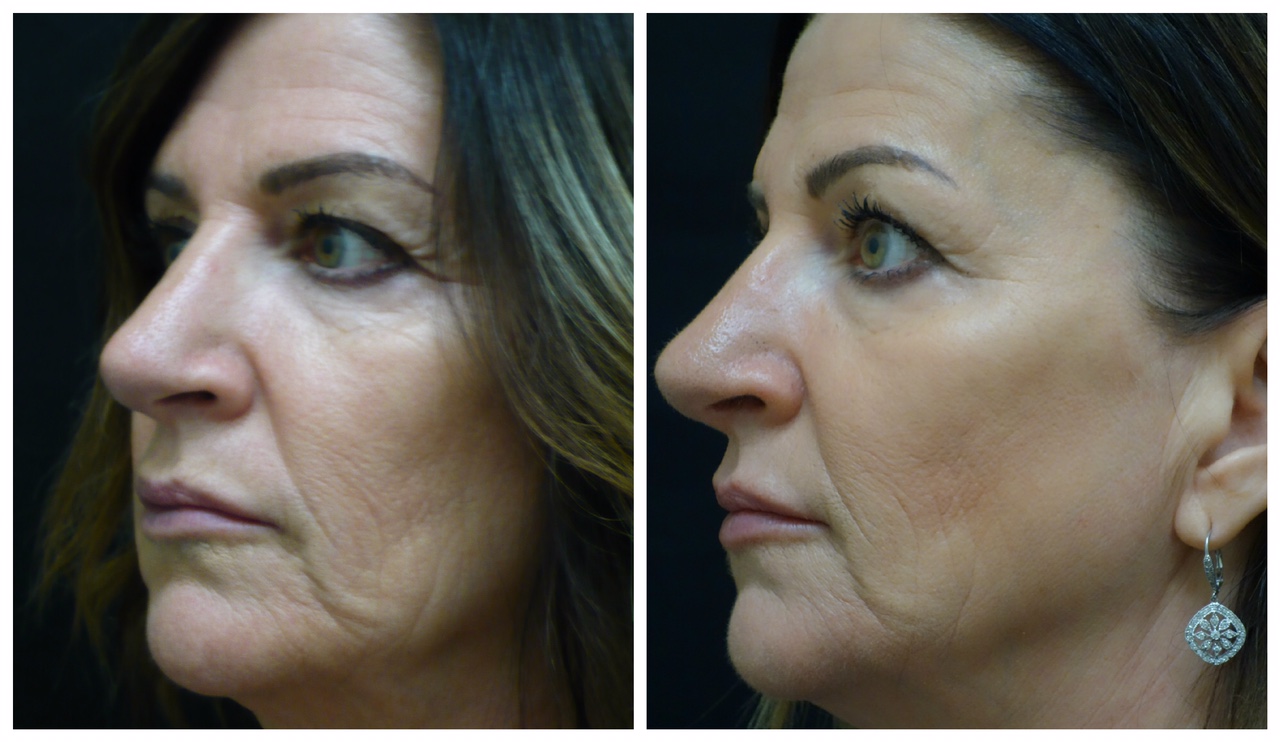 before and after BBL skin treatment