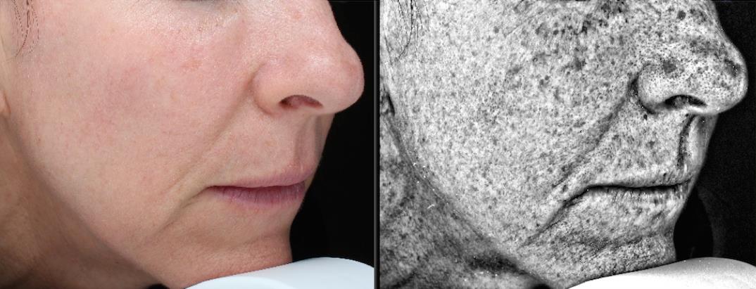 Visia skin analysis of skin damage