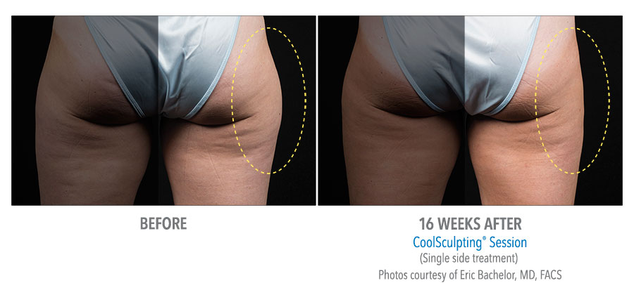 Outer thighs Before and After Treatment with Coolsculpting