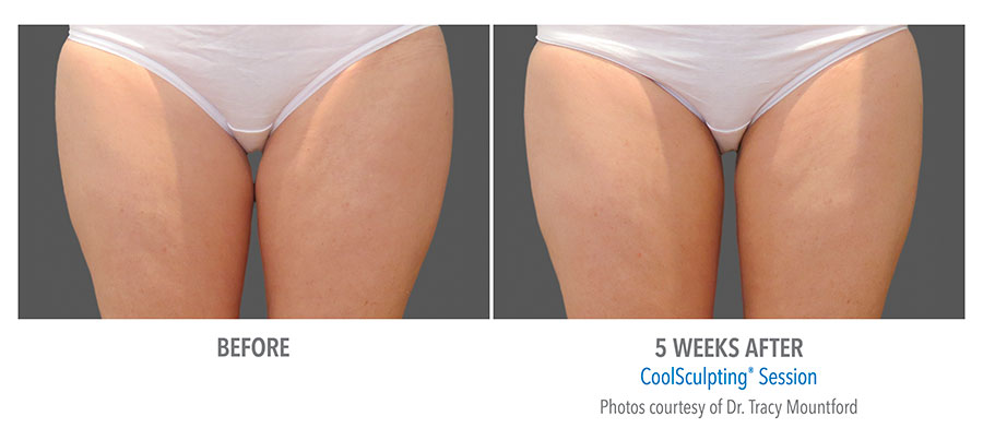 results after Coolsculpting treatment on inner thighs