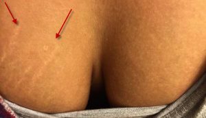 stretch marks on breast before and after